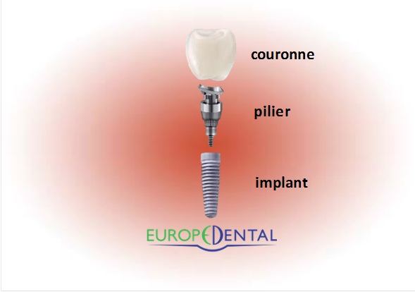 implant dentaire